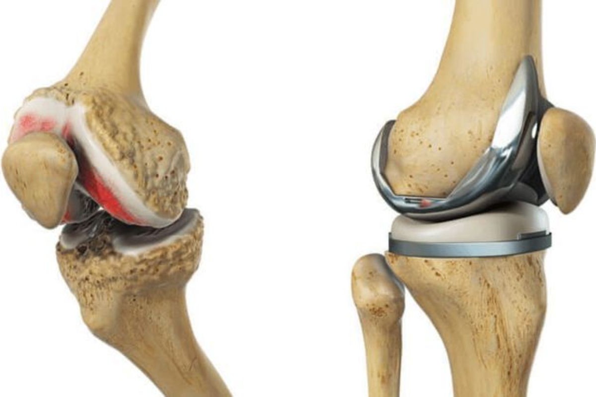 Understanding Joint Replacement Surgery: When Is It the Right Choice?