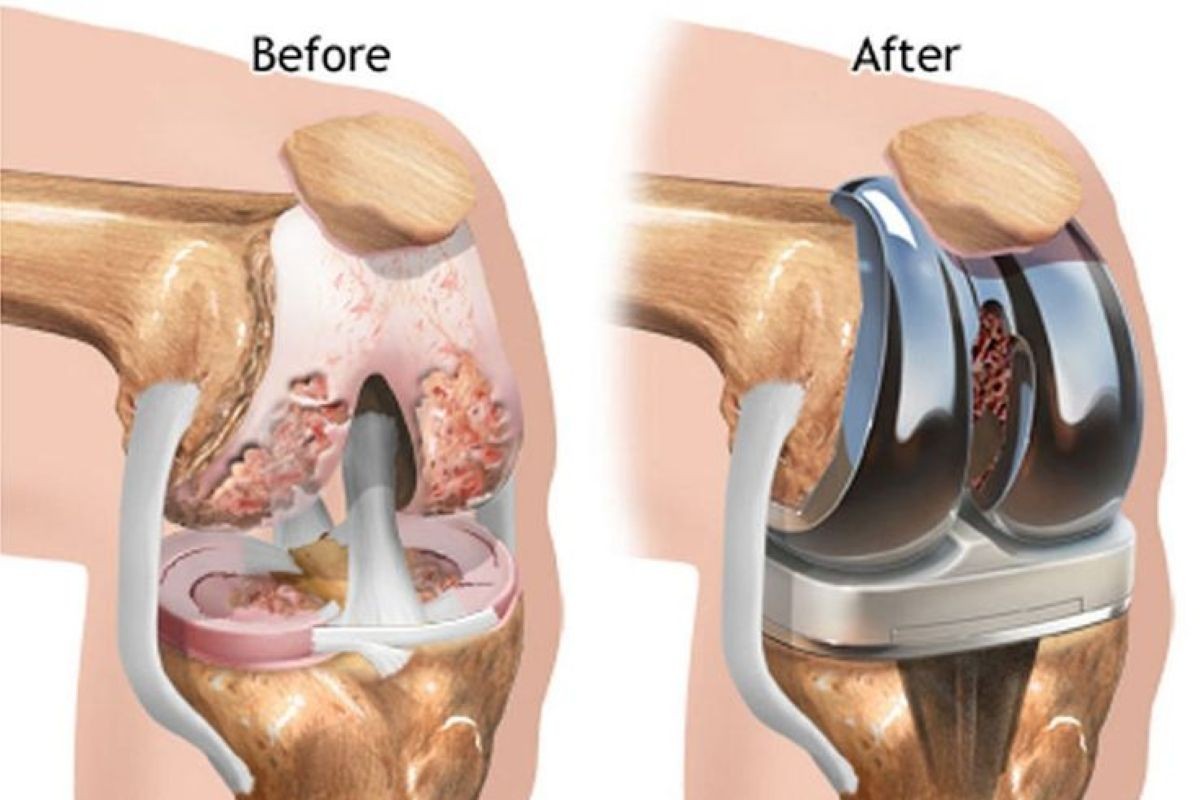 Joint Replacement
